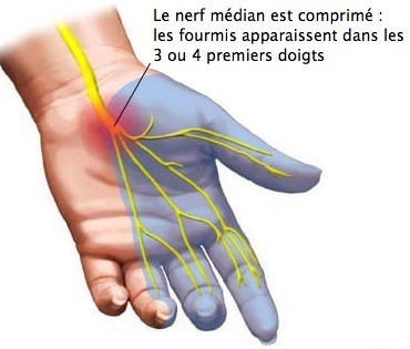 Compression Nerf - Centre Orthopédique Pasteur Lanroze